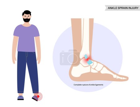 Illustration for Sprained ankle injury. Twisted feet, pain and swelling. Tears, stretch or rupture of ligaments. Foot trauma anatomical poster, diagnosis and treatment in clinic. Leg problem, X ray vector illustration - Royalty Free Image