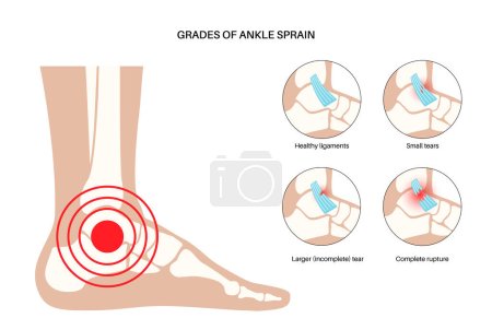 Illustration for Sprained ankle grades. Twisted feet, pain and swelling. Tears, stretch or rupture of ligaments. Foot trauma anatomical poster, diagnosis and treatment in clinic. Leg injury, X ray vector illustration - Royalty Free Image