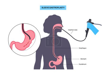 Endoscopic sleeve gastroplasty. Stomach surgery, weight loss gastric procedure. Laparoscopy concept. Overweight problem in human body. Internal organ after operation. Flat vector medical illustration