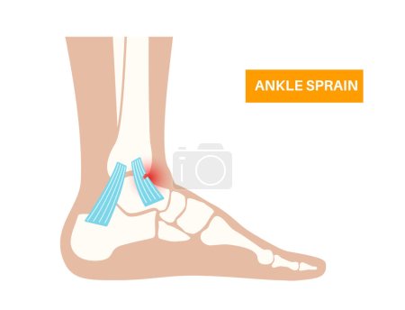 Sprained ankle injury. Twisted feet, pain and swelling. Tears, stretch or rupture of ligaments. Foot trauma anatomical poster, diagnosis and treatment in clinic. Leg problem, X ray vector illustration