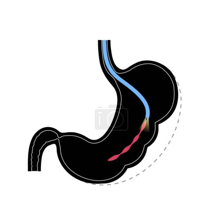 Illustration for Endoscopic sleeve gastroplasty. Stomach surgery, weight loss gastric procedure. Laparoscopy concept. Overweight problem in human body. Internal organ after operation. Flat vector medical illustration - Royalty Free Image