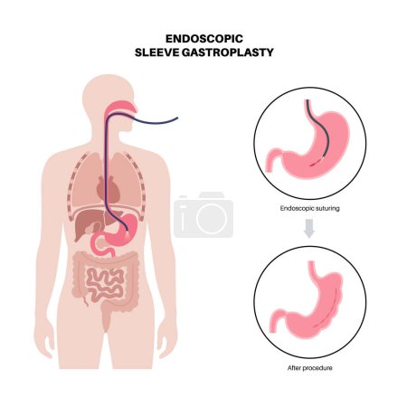 Illustration for Endoscopic sleeve gastroplasty. Stomach surgery, weight loss gastric procedure. Laparoscopy concept. Overweight problem in human body before and after operation. Flat vector medical illustration - Royalty Free Image