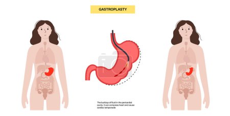 Illustration for Endoscopic sleeve gastroplasty. Stomach surgery, weight loss gastric procedure. Laparoscopy concept. Overweight problem in human body before and after operation. Flat vector medical illustration - Royalty Free Image