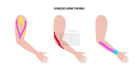 Illustration for Elastic therapeutic tape. Kinesiology tape on arm. KT method, elastic strip purported to ease pain from injuries. Protection and fixation for elbow muscles and wrist ligaments vector illustration. - Royalty Free Image