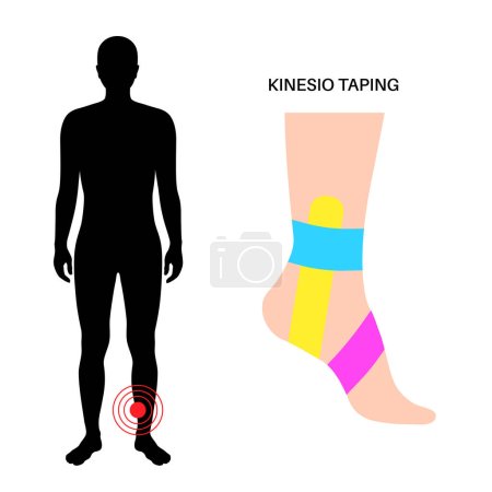 Elastic therapeutic tape. Kinesiology tape on the human ankle. KT method, elastic strip purported to ease pain from athletic injuries. Protection for muscles and ligaments flat vector illustration.