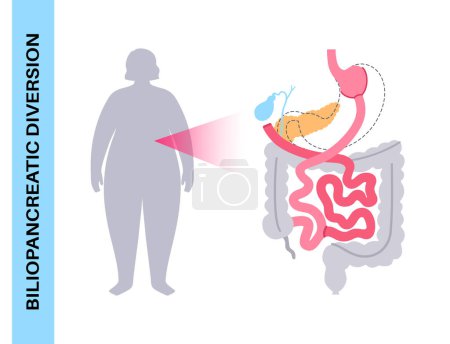 Illustration for Biliopancreatic diversion gastroplasty operation. BPD stomach surgery, weight loss gastric procedure. Abdomen laparoscopy. Overweight problem, female silhouette with obesity flat vector illustration - Royalty Free Image