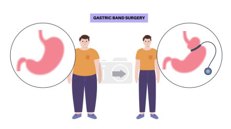 Illustration for Gastric band medical procedure. AGB stomach surgery concept, obesity problem, weight loss process. Abdomen laparoscopy anatomical poster. Overweight in human body flat vector illustration for clinic - Royalty Free Image