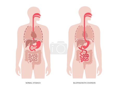 Illustration for Biliopancreatic diversion with duodenal switch. BPD stomach surgery, weight loss gastric procedure. Internal organs before and after operation. Overweight and obesity problem flat vector illustration - Royalty Free Image