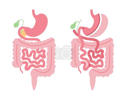 Biliopancreatic diversion with duodenal switch. BPD stomach surgery, weight loss gastric procedure. Internal organs before and after operation. Overweight and obesity problem flat vector illustration