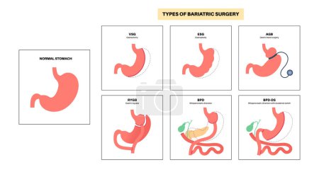 Types de chirurgie bariatrique. Un estomac sain et les organes internes après l'opération, la perte de poids procédure gastrique. Concept de laparoscopie abdominale. Problème d'embonpoint et d'obésité illustration vectorielle plate