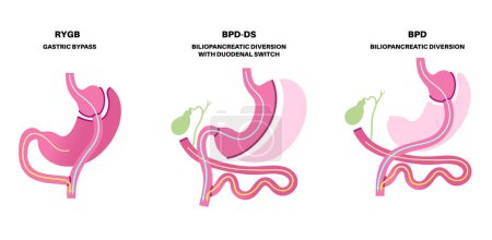 Illustration for Biliopancreatic diversion with duodenal switch and gastric bypass. Stomach surgery weight loss procedure. Internal organs before and after operation. Overweight and obesity problem vector illustration - Royalty Free Image