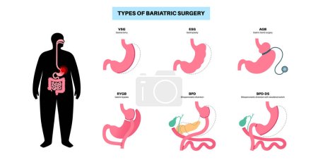 Illustration for Types of bariatric surgery. Healthy stomach and internal organs after operation, weight loss gastric procedure. Abdomen laparoscopy concept. Overweight and obesity problem flat vector illustration - Royalty Free Image