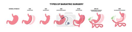 Illustration for Types of bariatric surgery. Healthy stomach and internal organs after operation, weight loss gastric procedure. Abdomen laparoscopy concept. Overweight and obesity problem flat vector illustration - Royalty Free Image