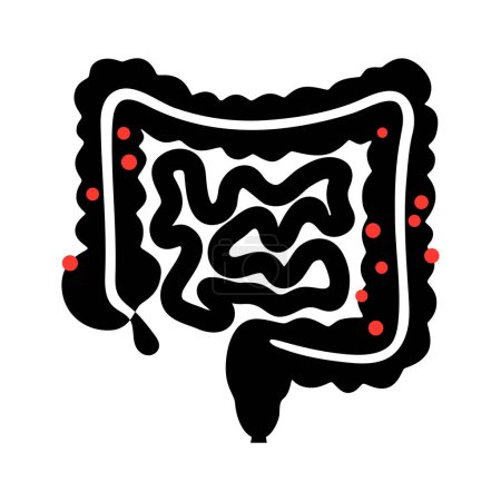 Ilustración de Diverticulitis y diverticulosis. Diverticula en las paredes del intestino. Dolor en el colon. Inflamación o infección en el intestino humano. Bolsas abultadas en el sistema digestivo ilustración vectorial plana - Imagen libre de derechos
