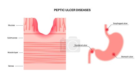 Ilustración de Enfermedad de úlcera péptica. Dolor en la pared interior del estómago. Dolor abdominal en el cuerpo humano. Infección del tracto digestivo. Úlceras duodenales, gástricas o esofágicas, ilustración vectorial anatómica - Imagen libre de derechos