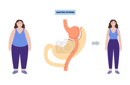 Illustration for Gastric bypass gastroplasty operation. Female body before and after stomach surgery. Obesity problem, weight loss procedure. Abdomen laparoscopy medical poster. Overweight problem vector illustration - Royalty Free Image