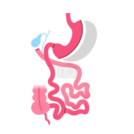 Biliopancreatic diversion with duodenal switch. BPD stomach surgery concept, weight loss gastric procedure. Abdomen laparoscopy. Overweight and obesity in human body flat vector medical illustration