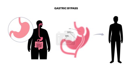 Illustration for Gastric bypass gastroplasty operation. Male body before and after stomach surgery. Obesity problem, weight loss procedure. Abdomen laparoscopy medical poster. Overweight problem vector illustration - Royalty Free Image