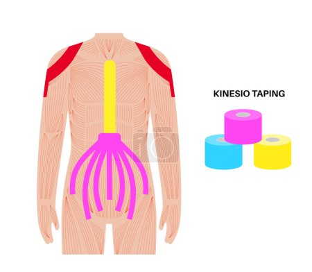 Illustration for Elastic therapeutic tape. Kinesiology tape on shoulder and abdomen. KT method, elastic strip purported to ease pain from athletic injuries. Protection for muscles and ligaments vector illustration. - Royalty Free Image