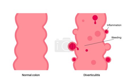 Illustration for Diverticulitis and diverticulosis diseases. Diverticula in the walls of intestine. Pain in colon. Inflammation or infection in human bowel. Bulging pouches in digestive system flat vector illustration - Royalty Free Image