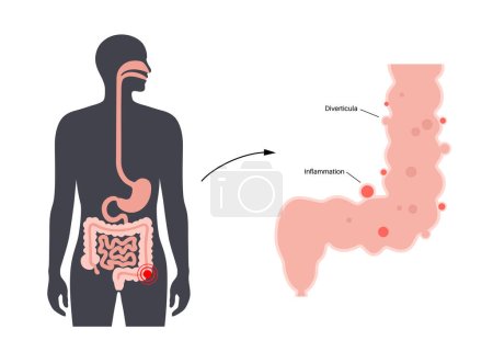 Diverticulitis and diverticulosis diseases. Diverticula in the walls of intestine. Pain in colon. Inflammation or infection in human bowel. Bulging pouches in digestive system flat vector illustration