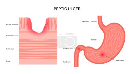 Illustration for Peptic ulcer disease. Sore on wall of the stomach. Abdomen pain in the human body. Infection in the digestive tract. Gastroenterology concept. Gastric problems, anatomical flat vector illustration. - Royalty Free Image