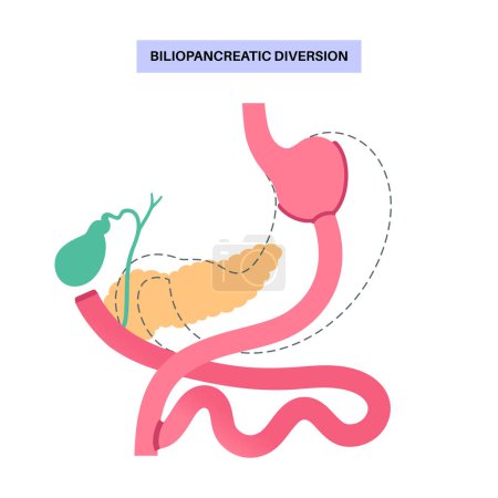 Illustration for Biliopancreatic diversion gastroplasty operation. BPD stomach surgery concept, weight loss gastric procedure. Abdomen laparoscopy. Overweight problem in human body flat vector medical illustration - Royalty Free Image
