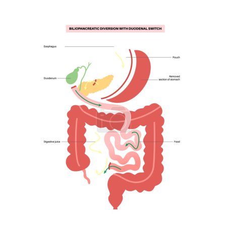 Illustration for Biliopancreatic diversion with duodenal switch. BPD stomach surgery concept, weight loss gastric procedure. Abdomen laparoscopy. Overweight and obesity in human body flat vector medical illustration - Royalty Free Image