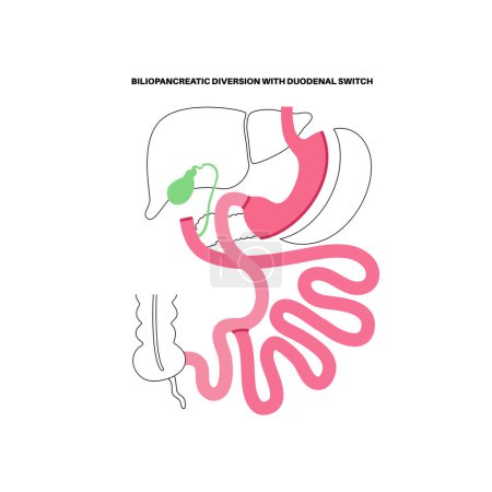 Illustration for Biliopancreatic diversion with duodenal switch. BPD stomach surgery concept, weight loss gastric procedure. Abdomen laparoscopy. Overweight and obesity in human body flat vector medical illustration - Royalty Free Image