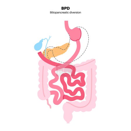 Illustration for Biliopancreatic diversion gastroplasty operation. BPD stomach surgery concept, weight loss gastric procedure. Abdomen laparoscopy. Overweight problem in human body flat vector medical illustration - Royalty Free Image