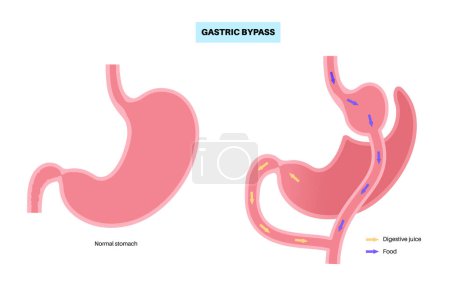 Illustration for Gastric bypass gastroplasty stomach operation. Human organs before and after surgery. Obesity problem, weight loss procedure. Abdomen laparoscopy medical poster. Overweight problem vector illustration - Royalty Free Image
