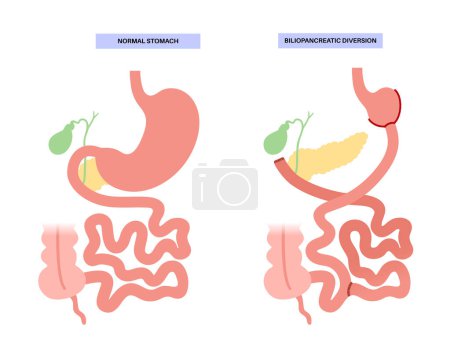 Illustration for Biliopancreatic diversion gastroplasty. BPD stomach surgery, weight loss gastric procedure. Abdomen laparoscopy. Internal organs before and after operation. Overweight problem flat vector illustration - Royalty Free Image