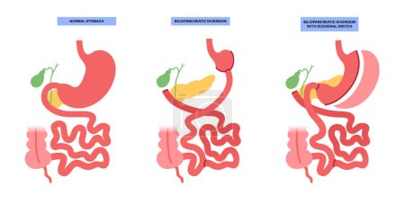Illustration for Biliopancreatic diversion with duodenal switch. BPD stomach surgery, weight loss gastric procedure. Internal organs before and after operation. Overweight and obesity problem flat vector illustration - Royalty Free Image