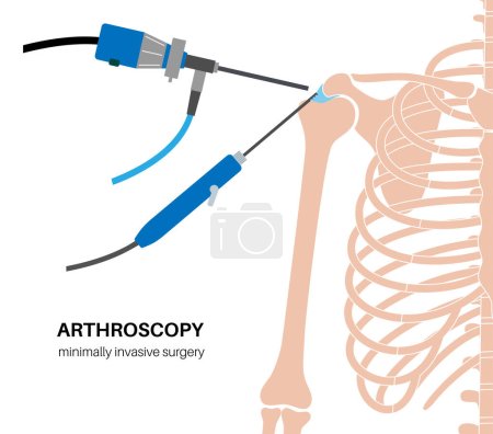 Illustration for Shoulder arthroscopy procedure. Rotator cuff tears or shoulder joint replacement. Minimally invasive surgery. Ligaments treatment, tendonitis pain or arthritis inflammation medical vector illustration - Royalty Free Image