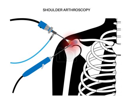 Illustration for Shoulder arthroscopy procedure. Rotator cuff tears or shoulder impingement. Minimally invasive surgery. Arthroscopic joint treatment, pain and inflammation in human body x ray flat vector illustration - Royalty Free Image