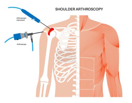 Shoulder arthroscopy procedure. Rotator cuff tears, shoulder muscles problem. Minimally invasive surgery. Arthroscopic joint and ligaments treatment, pain or inflammation in the human body flat vector