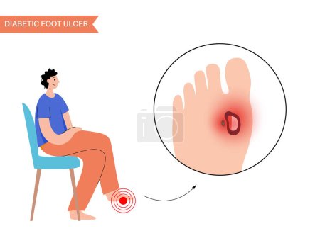 Illustration for Diabetic foot syndrome. Deep ulcer, open sore or wound on the feet. Inflammation in the ligaments, tendon and bones. Gangrene infection and amputation. Pain in leg, diagnostic and treatment vector - Royalty Free Image