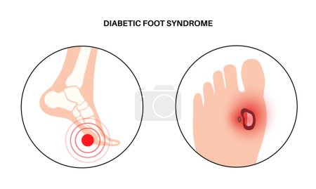 Syndrome du pied diabétique. Ulcère profond, plaie ouverte ou plaie aux pieds. Inflammation des ligaments, des tendons et des os. Infection au gangrène et amputation. Douleur dans la jambe, vecteur de diagnostic et de traitement