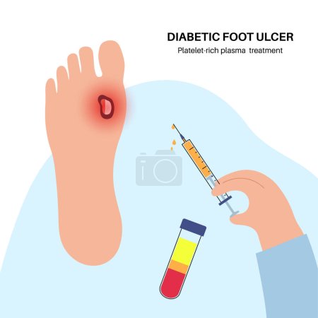 Ilustración de Tratamiento del síndrome del pie diabético con plasma rico en plaquetas. Concepto de inyección PRP. Úlcera, llaga abierta o herida en los pies. Inflamación en piel y ligamentos. Dolor e infección en la pierna vector plano médico - Imagen libre de derechos
