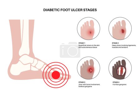 Stades du syndrome du pied diabétique. Ulcère profond, plaie ouverte ou plaie aux pieds. Inflammation des ligaments, des tendons et des os. Infection au gangrène et amputation. Douleur dans la jambe, vecteur de diagnostic et de traitement.