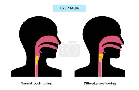 Dysphagia medical poster. Difficult or painful swallowing. Esophagus disease concept. Difficulty in the passage of solids or liquids from the mouth to the stomach. Digestive tract problem flat vector