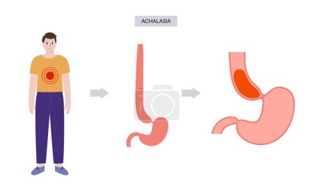 Illustration for Esophageal achalasia medical poster. Failure of smooth muscle fibers to relax. Gastrointestinal tract disease. Closed lower esophageal sphincter, digestive system disorder flat vector illustration. - Royalty Free Image