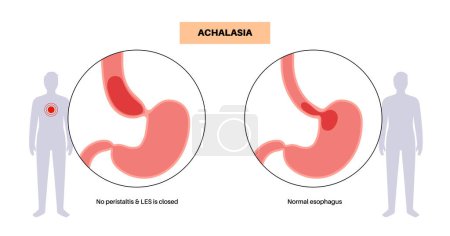 Illustration for Esophageal achalasia medical poster. Failure of smooth muscle fibers to relax. Gastrointestinal tract disease. Closed lower esophageal sphincter, digestive system disorder flat vector illustration. - Royalty Free Image