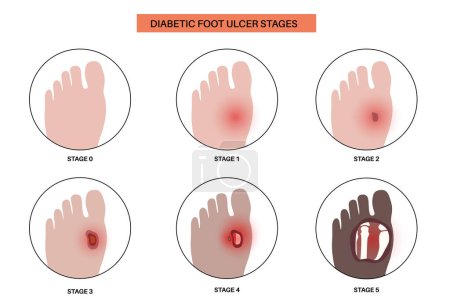 Diabetic foot syndrome stages. Deep ulcer, open sore or wound on feet. Inflammation in the ligaments, tendon and bones. Gangrene infection and amputation. Pain in leg, diagnostic and treatment vector.