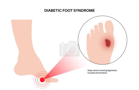 Síndrome del pie diabético. Úlcera profunda, llaga abierta o herida en los pies. Inflamación en los ligamentos, tendones y huesos. Infección por gangrena y amputación. Dolor en la pierna, diagnóstico y vector de tratamiento