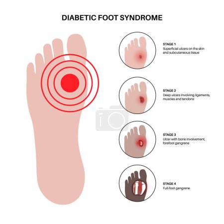 Diabetic foot syndrome stages. Deep ulcer, open sore or wound on feet. Inflammation in the ligaments, tendon and bones. Gangrene infection and amputation. Pain in leg, diagnostic and treatment vector.
