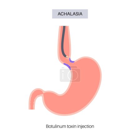 Illustration for Esophageal achalasia disease, botulinum toxin injection treatment. Failure of smooth muscle fibers to relax. Gastrointestinal tract disorder. Closed lower esophageal sphincter, digestive system vector - Royalty Free Image
