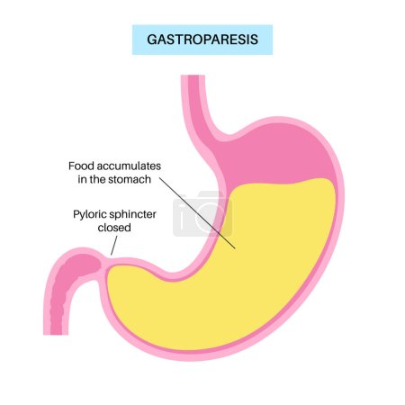 Illustration for Gastroparesis disorder. Delayed gastric emptying concept. muscular contractions of the stomach. Nausea, vomiting, abdominal pain in human body. Diseases of digestive tract flat vector illustration. - Royalty Free Image