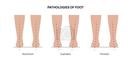 Illustration for Pronation, overpronation, and supination foot position. Feet pathologies anatomical poster. Body balance problem. Ankle disease diagnostic and treatment in podiatry clinic medical vector illustration - Royalty Free Image