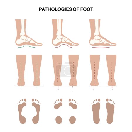 Foot pathologies anatomical poster. Flat, normal and hollow feet conditions. Abnormal feet arch, supination and overpronation. Ankle pathology diagnostic in podiatry clinic medical vector illustration